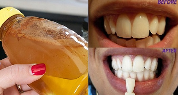 gargle-with-one-simple-ingredient-and-see-what-happens-to-your-teeth