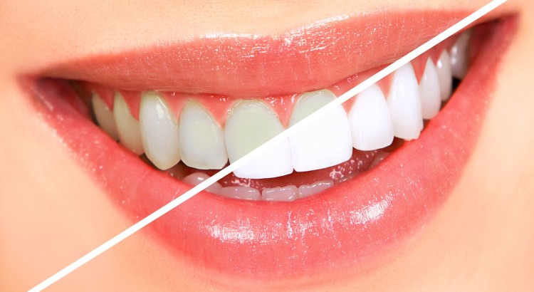 Cosmetic Dentistry for Teeth whitening