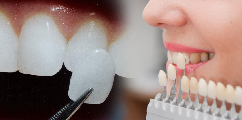 Dental bonding and veneers in cosmetic dentistry