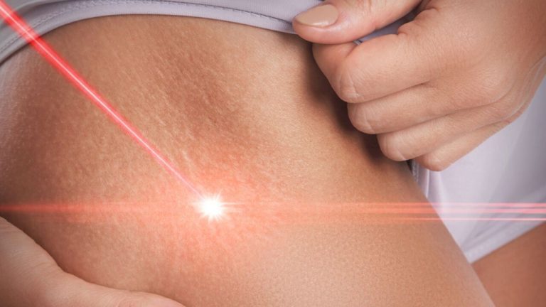 stretch marks removal laser