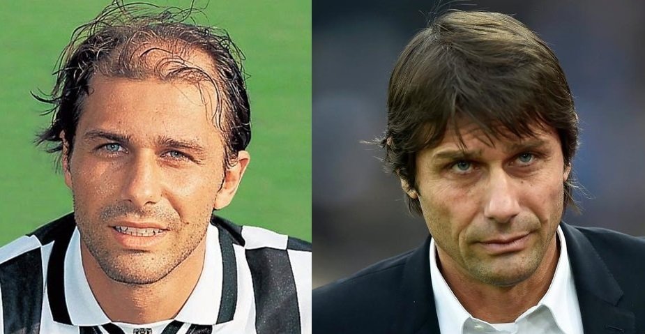 Antonio Conte's Hair Transplant