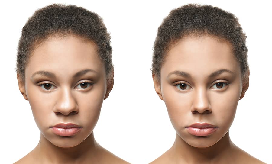 ethnic rhinoplasty benefits