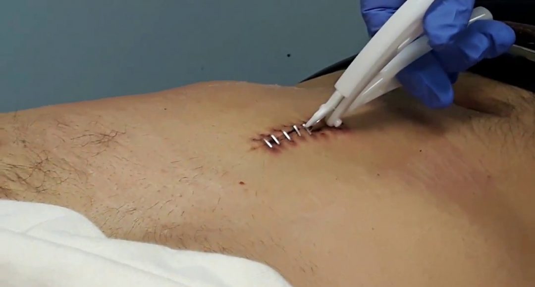 surgical staples on skin