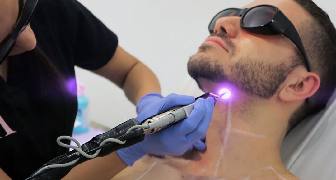 Laser Hair Removal For Men: Now More Affordable than Ever