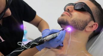Laser Hair Removal For Men: Now More Affordable than Ever