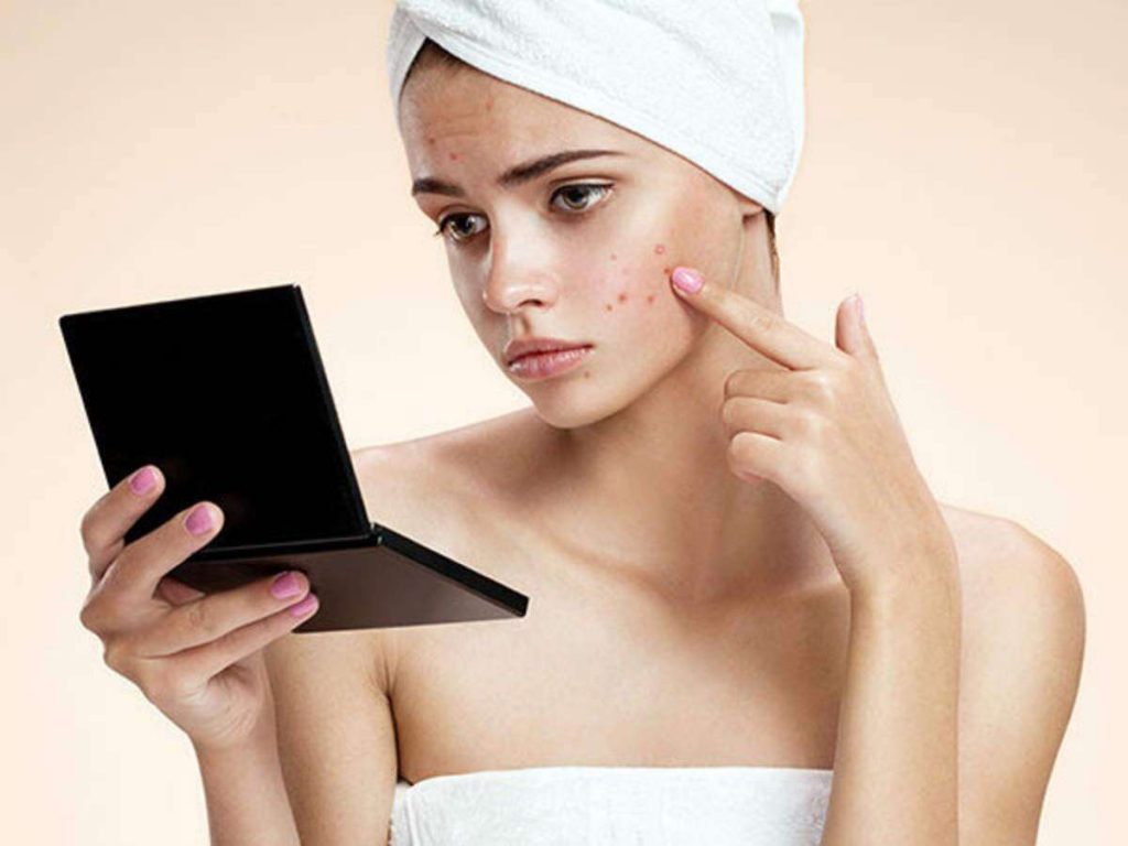  how to avoid acne scarring