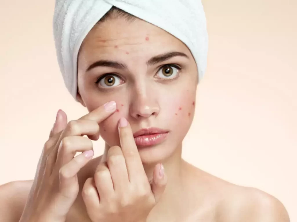 Acne Treatment For Teenage Girls: A Routine To Follow